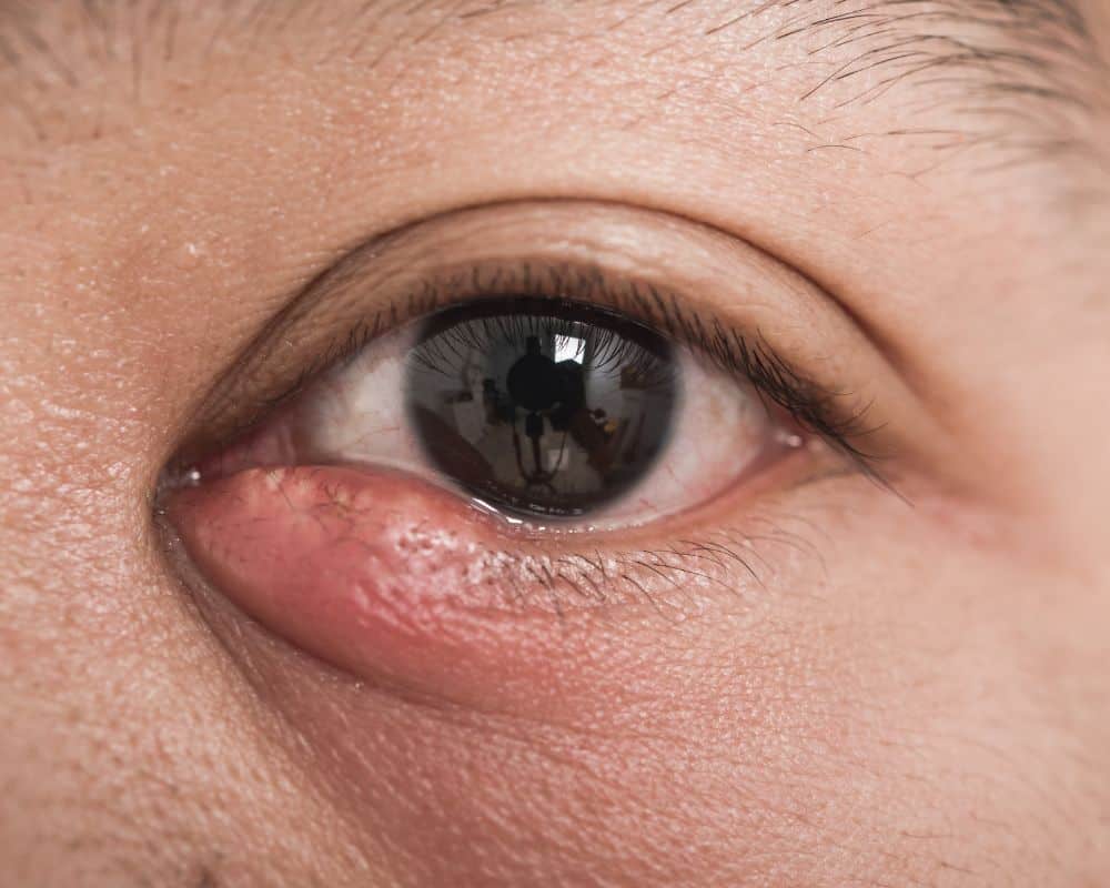 stye eye