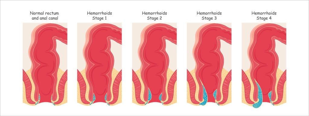 Colon Polyp Size Chart