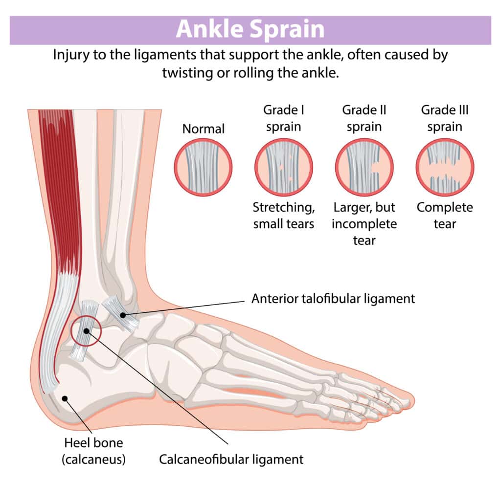 Ankle Injury Diagnosis Chart: Your Guide to Identifying Ankle Pain 2