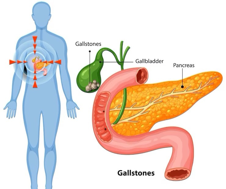 Gallstones position on gallbladder