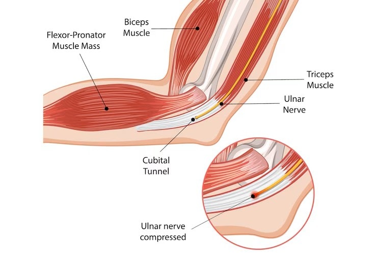 Pronator Teres Muscle