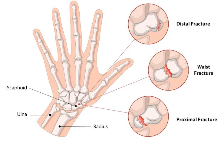 Wrist Fracture